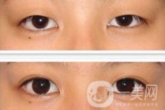 全切雙眼皮術(shù)后怎么護(hù)理？需要注意什么