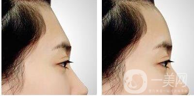 墊額頭手術(shù),有哪些注意事項(xiàng)