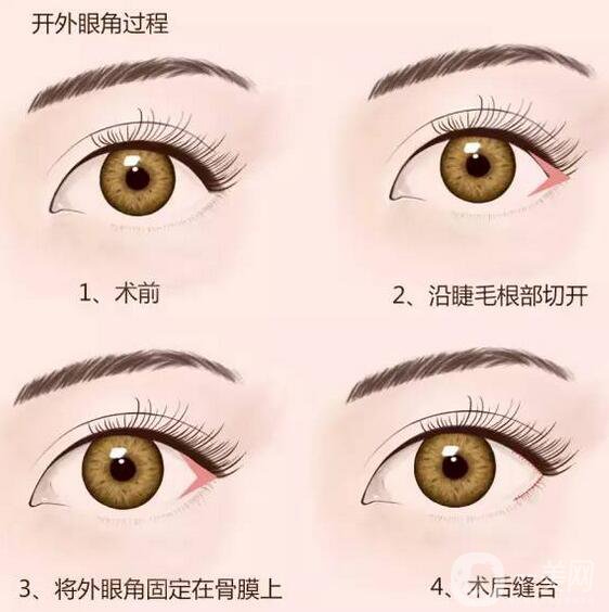 開眼角*果怎么樣？手術風險大不大