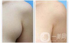 副乳是什么？副乳切除手術(shù)需要多久