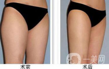 大腿吸脂多久恢復？大腿吸脂后遺癥有哪些
