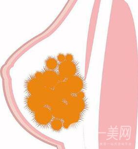 取出乳房奧美定*果怎么樣？取出*嗎？