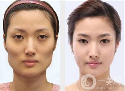 磨顴骨手術(shù)之后容易有后遺癥么？主要有哪些情況？