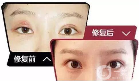 雙眼皮增生是什么樣子？