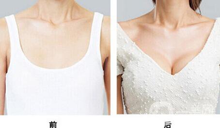 假體隆胸多久開始按摩？具體如何操作