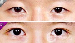 埋線雙眼皮之后禁忌有哪些？具體注意事項(xiàng)介紹