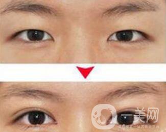 埋線雙眼皮之后禁忌有哪些？具體注意事項介紹