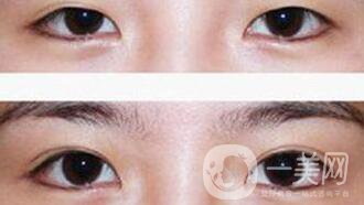 疤痕體質(zhì)能割雙眼皮嗎