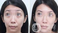 抬頭紋能消除嗎？用什么方法祛除抬頭紋