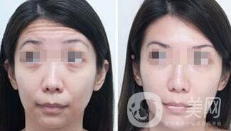 抬頭紋能消除嗎？用什么方法祛除抬頭紋