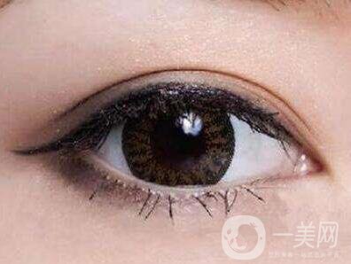 埋線雙眼皮要拆線嗎？如何護理？