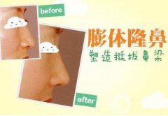 膨體隆鼻后期果怎么樣呢?果圖有嗎？