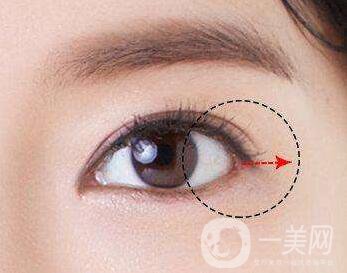 開眼角手術(shù)術(shù)前檢查什么？