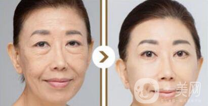 塑美極*果怎么樣？塑美極的副作用
