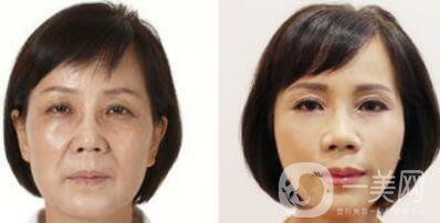 塑美極*果怎么樣？塑美極的副作用