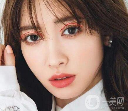 焊接雙眼皮是什么？多久能好？