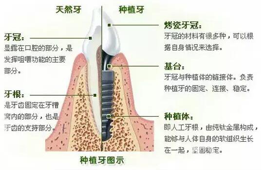 昆山種植牙價(jià)格要多少錢