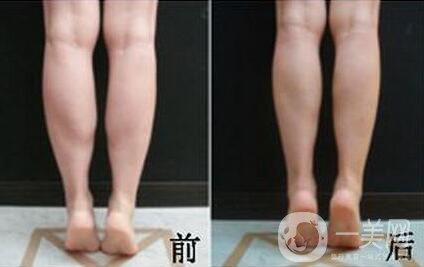 *注射瘦小腿*果怎么樣？
