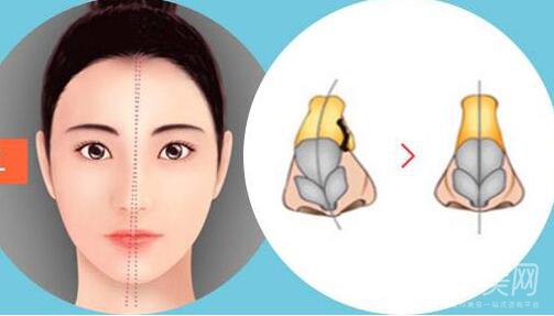 歪鼻矯正手術多少錢？