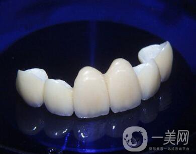 金鈀合金烤瓷牙價格多少錢？