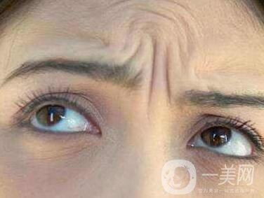 抬頭紋能消除嗎？有哪些方法？