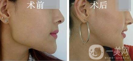 磨骨多少錢？磨骨價格盤點！