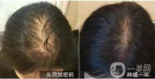 北京做植發(fā)手術(shù)哪里*果好？