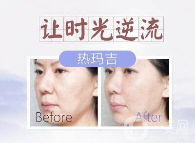 塑美極的副作用有哪些？