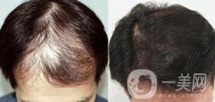 鄭州植發(fā)醫(yī)院信息介紹？植發(fā)去介紹