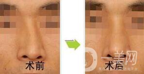 歪鼻矯正需要恢復多久？術后需要注意什么