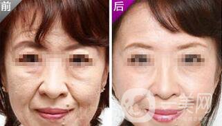 小切口面部提升*果怎么樣？會不會留疤