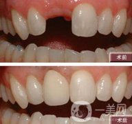 種植牙有什么優(yōu)點(diǎn)？北京種植牙介紹?