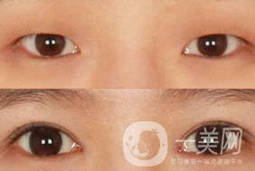韓式三點(diǎn)法割雙眼皮手術(shù)的價(jià)格一般是多少