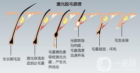 北京激光脫毛費(fèi)用介紹 價格詳情