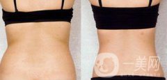 后背吸脂后多久消腫？吸脂術后如何護理