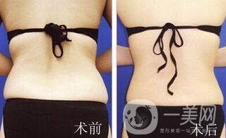 后背吸脂后多久消腫？吸脂術(shù)后如何護(hù)理