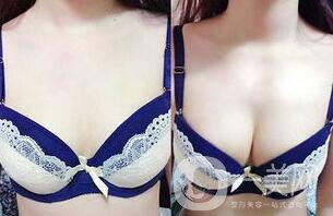 脂肪隆胸失敗如何修復(fù)？隆胸修復(fù)多少錢