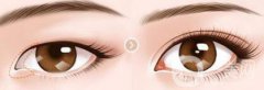 開(kāi)眼角幾天恢復(fù)？開(kāi)眼角手術(shù)費(fèi)用介紹