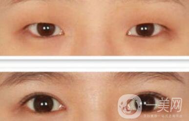 開眼角幾天恢復(fù)？開眼角手術(shù)費(fèi)用介紹
