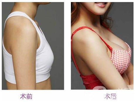 隆胸恢復(fù)期多久正常 隆胸恢復(fù)時間要多久 2