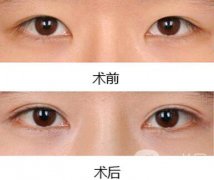 雙眼皮增生了怎么處理？雙眼皮修復(fù)價(jià)格多少
