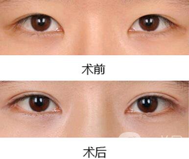 雙眼皮增生了怎么處理？雙眼皮修復價格多少