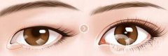 開(kāi)眼角術(shù)后注意事項(xiàng)具體有哪些