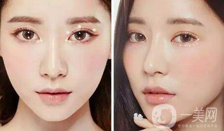 雙眼皮拆線后怎么護(hù)理？