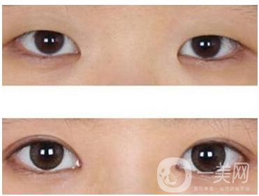 開眼角手術(shù)之后會疤痕增生嗎
