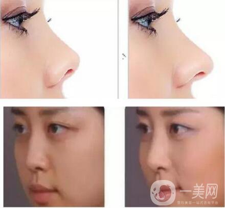 鼻小柱延長恢復(fù)過程是怎樣的