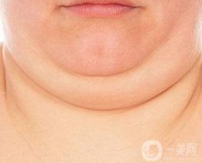 有雙下巴了怎么辦呢?去雙下巴的方法有哪些呢？