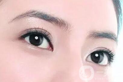 割雙眼皮痕跡多久消失？