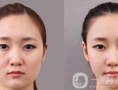 顴骨手術(shù)多長(zhǎng)時(shí)間恢復(fù)？
