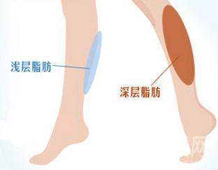 小腿吸脂手術(shù)后多久會(huì)*變瘦